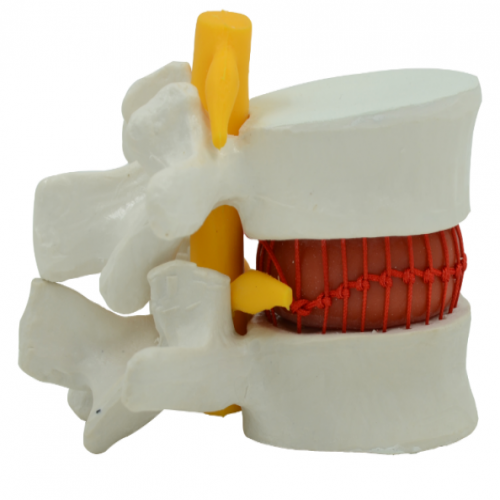 椎間盤突出模型（動(dòng)態(tài)演示）